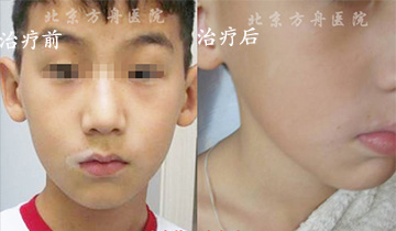 患者案例:亚力山大 北京白癜风医院患者案例