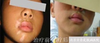 患者案例:张某 北京白癜风医院患者案例