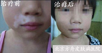 北京白癜风医院患者案例 北京白癜风医院患者案例