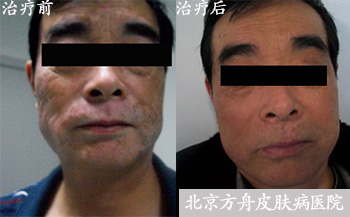 北京白癜风医院患者案例 北京白癜风医院患者案例