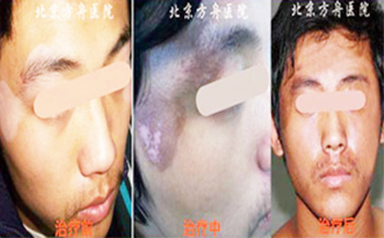 患者案例:韦某 北京白癜风医院患者案例
