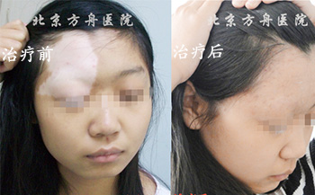 北京白癜风医院患者案例 北京白癜风医院患者案例