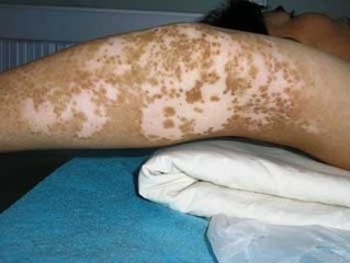 患上了白癜风都有哪些征兆呢(图1)