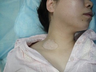 有效治疗女性白癜风的方法是什么?(图1)