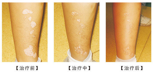 如何科学的治疗白癜风呢