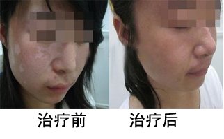 女性白癜风患者不能使用化妆品吗?(图1)