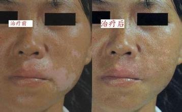 白癜风会带来哪些并发症?(图1)