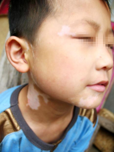 孩子身上的白癜风是不是遗传的呢?(图1)