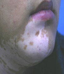 马春林：白癜风患者必知的危害有哪些?(图1)