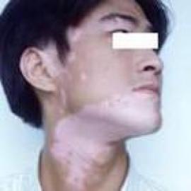 颈部白癜风的症状表现是怎么样的?(图1)