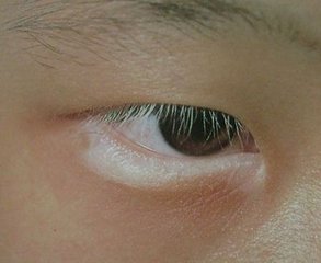方舟马春林：晕痣型白癜风的临床表现有哪些?(图1)