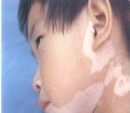避免青少年诱发白癜风的有效措施?(图1)