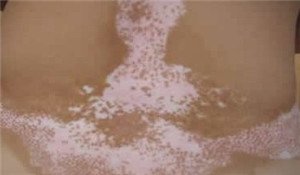 白癜风给患者带来的三大伤害?(图1)
