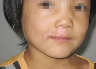 孩子脸上出现白癜风怎么办?(图1)