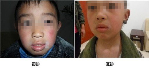 儿童面部白斑会造成哪些影响呢?(图1)