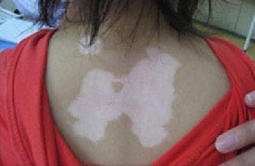 如何做有助于白癜风的恢复呢?(图1)
