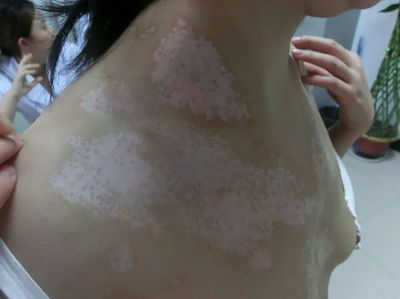 治疗胸部白癜风需要多少钱?(图1)
