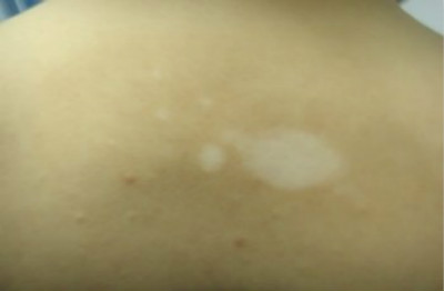 毛囊性白癜风有哪些症状?(图1)