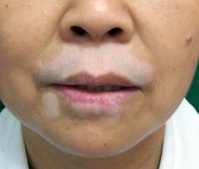 嘴唇白癜风护理怎么做?(图1)