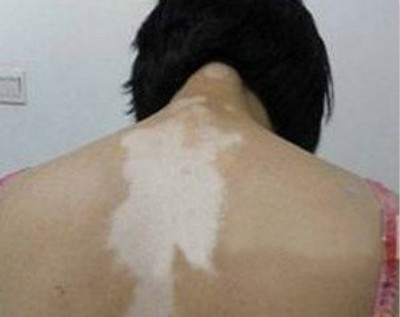 节段型白癜风应该怎么治疗呢?(图1) 节段型白癜风应该怎么治疗呢?(图1)