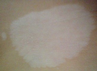 女性白癜风是和哪些原因有关呢？(图1)