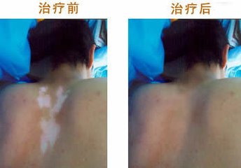 白癜风与其他白斑病有什么区别?(图1)