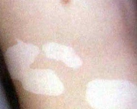 如何调节白癜风患者的心理问题?(图1)