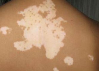 孩子患了白癜风应该怎么办?(图1)