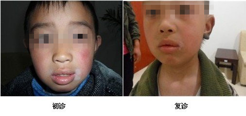 胎记跟白癜风的症状有啥区别呢(图1)