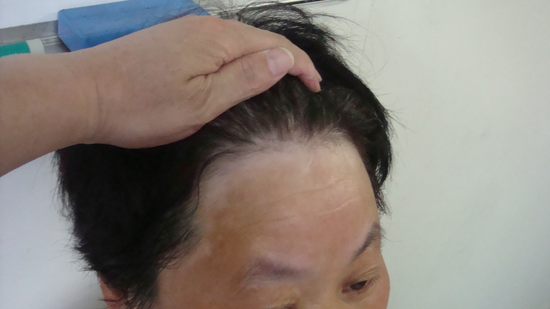怎样才能更好的去治疗白癜风呢(图1)