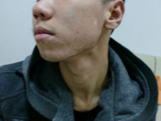 那白癜风白斑处脱皮怎么回事(图1)