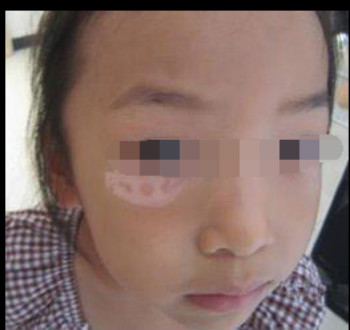 女性白癜风早期症状有哪些呢？(图1)