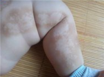 北京怎么预防儿童白癜风?(图1)