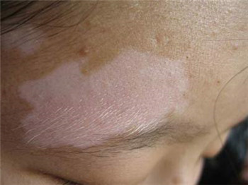 白癜风对患者的皮肤有什么危害?(图1) 白癜风对患者的皮肤有什么危害