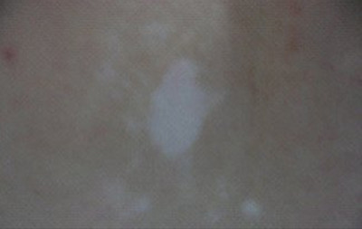 怎么样才能发现白癜风疾病呢