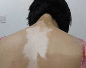 女性背部白癜风都需要注意什么