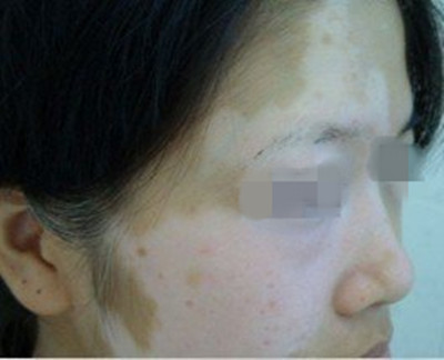 女性为什么会患上白癜风